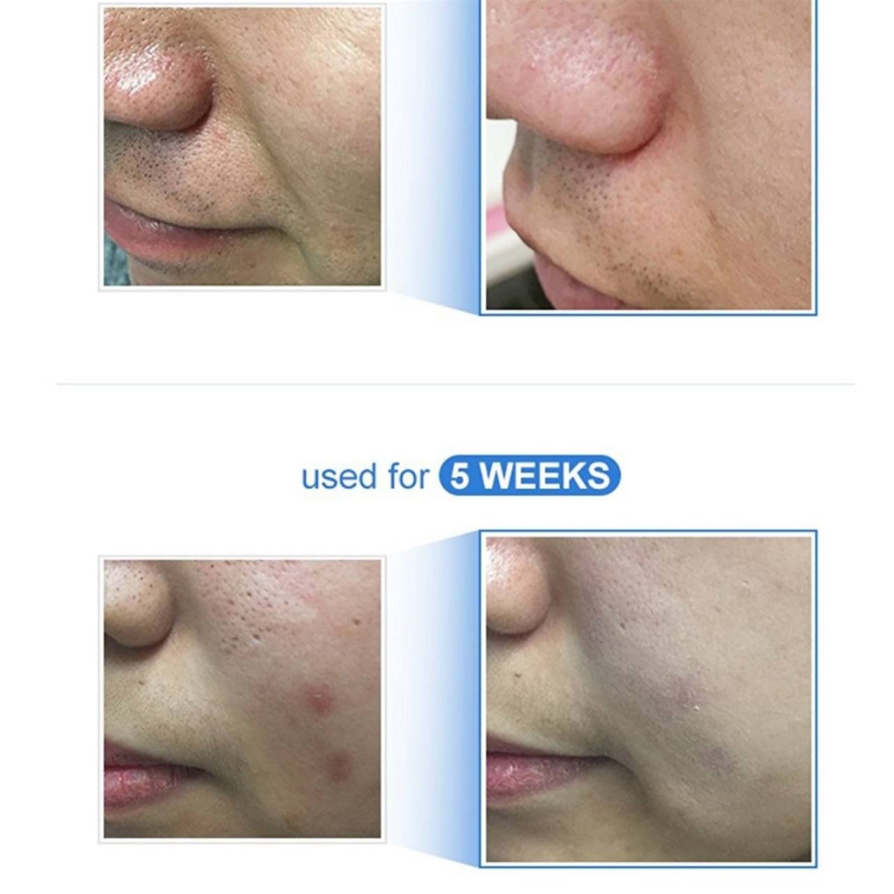 Medicube – Zero Pore Pad 2.0 70 шт