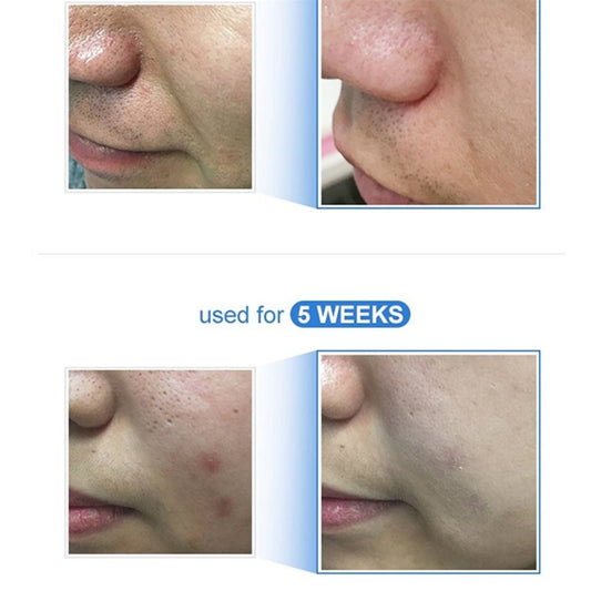 Medicube – Zero Pore Pad 2.0 70 шт